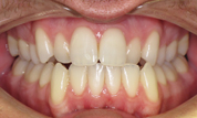 gallery-patient-13c-before-center