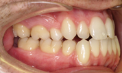 gallery-patient-13c-before-left