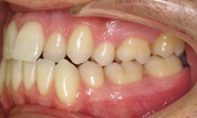 gallery-patient-13c-before-right