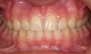 gallery-patient-14c-after-center