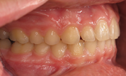 gallery-patient-14c-after-left