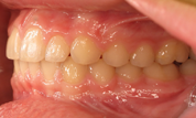 gallery-patient-14c-after-right