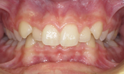 gallery-patient-14c-before-center