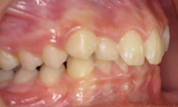 gallery-patient-14c-before-left