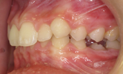 gallery-patient-14c-before-right