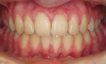 gallery-patient-15a-after
