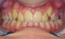 gallery-patient-15a-before