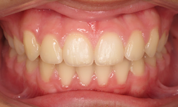 gallery-patient-15c-after-center