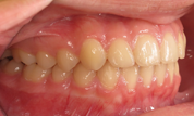 gallery-patient-15c-after-left