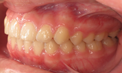 gallery-patient-15c-after-right
