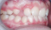 gallery-patient-15c-before-left