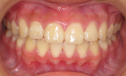 gallery-patient-16c-after-center