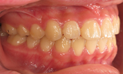 gallery-patient-16c-after-left