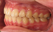 gallery-patient-16c-after-right