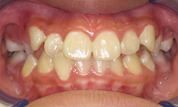 gallery-patient-16c-before-center