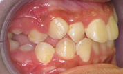 gallery-patient-16c-before-left