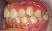 gallery-patient-16c-before-right