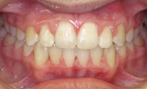 gallery-patient-17a-after