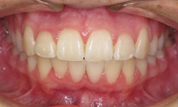 gallery-patient-17c-after-center
