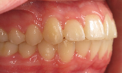 gallery-patient-17c-after-left