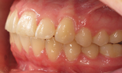 gallery-patient-17c-after-right