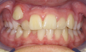 gallery-patient-17c-before-center