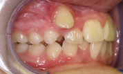 gallery-patient-17c-before-left