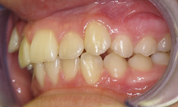 gallery-patient-17c-before-right