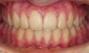 gallery-patient-18c-after-center