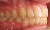 gallery-patient-18c-after-left