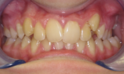 gallery-patient-18c-before-center