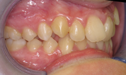 gallery-patient-18c-before-left