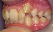 gallery-patient-18c-before-right