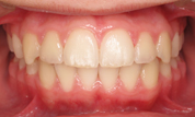 gallery-patient-19c-after-center