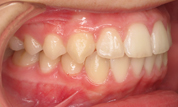 gallery-patient-19c-after-left