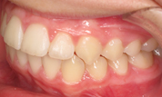 gallery-patient-19c-after-right