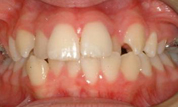 gallery-patient-19c-before-center
