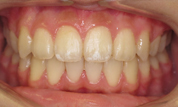 gallery-patient-20c-after-center
