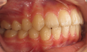 gallery-patient-20c-after-left
