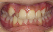 gallery-patient-20c-before-center