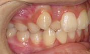 gallery-patient-20c-before-left