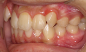 gallery-patient-20c-before-right
