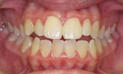 gallery-patient-21c-before-center