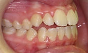 gallery-patient-21c-before-left