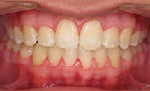 gallery-patient-23a-after