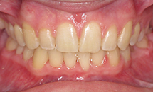 gallery-patient-24a-after