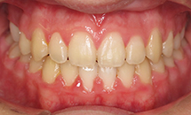 gallery-patient-26a-after