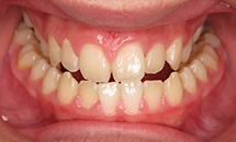 gallery-patient-26a-before