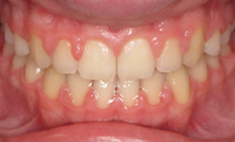 gallery-patient-27a-after