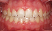 gallery-patient-27c-after-center